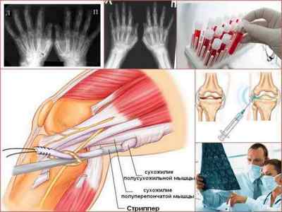 Псоріатичний артрит: симптоми, лікування, фото, діагностика