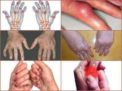Псоріатичний артрит: симптоми, лікування, фото, діагностика