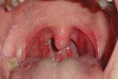 Пухирі в горлі і на мові (прищі, бульбашки, пухирці) у дитини і дорослого: причини білих, червоних, жовтих, сірих, гнійних пухирців на мигдалинах