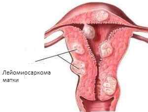 Пухлина матки: причини, симптоми і методи лікування