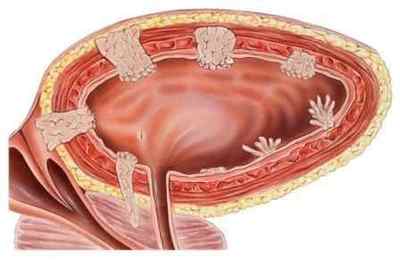 Пухлина сечового міхура у чоловіків: причини, симптоми і лікування