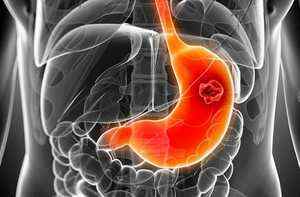 Пухлина шлунка: що це, види і їх симптоми, діагностика новоутворень