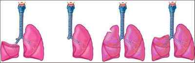 Пухлина в легенях: симптоми, ознаки, класифікація