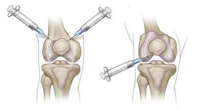 Пункція колінного і плечового суглоба: техніка виконання і наслідки, відгуки | Ревматолог