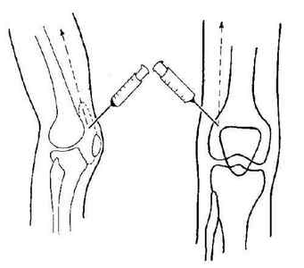 Пункція колінного суглоба: показання, техніка виконання, результат