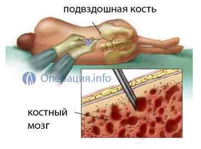 Пункція кісткового мозку (біопсія, трепанобиопсия)