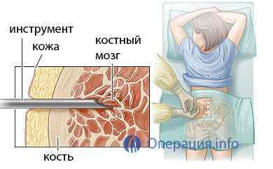 Пункція кісткового мозку (біопсія, трепанобиопсия)