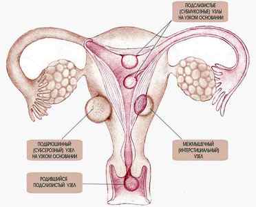 Пявки при міомі матки: ефективна гірудотерапія