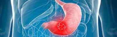 Рак антрального відділу шлунка: причини, стадії і симптоми, класифікація
