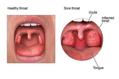 Рак горла: симптоми і ознаки