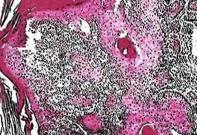 Рак горла у чоловіків: симптоми і перші ознаки
