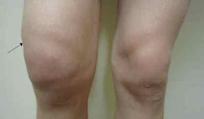 Рак колінного суглоба: симптоми онкології, метастази і характеристика колінного суглоба | Ревматолог