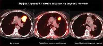 Рак легенів: методи лікування і терапії онкологічних захворювань