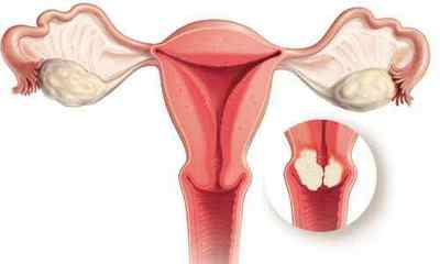 Рак матки на УЗД: підготовка до процедури і розшифровка результатів