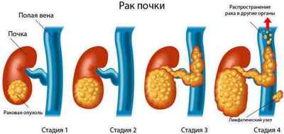 Рак нирки: симптоми і ознаки 1вЂ "4 стадії