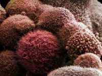 Рак підшлункової залози 4 стадії: скільки живуть, дієта, хіміотерапія, відгуки