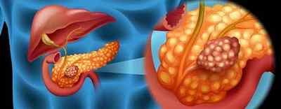 Рак підшлункової залози: перші симптоми, прояви, скільки живуть з метастазами в печінку