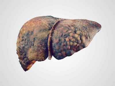 Рак печінки: причини, види, діагностика, лікування та прогноз