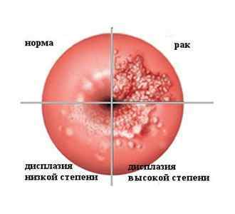 Рак шийки матки і вагітність: вірогідність зачаття