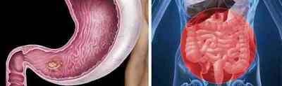 Рак шлунка 3 стадія: підвиди, діагностика, методи лікування і прогноз