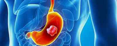 Рак шлунка: прогноз і тривалість життя після встановлення діагнозу