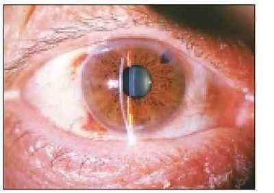 Ірідектомія (ірідотомія): суть операції, лазерна і хірургічна