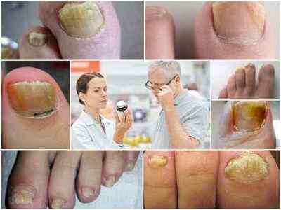Рідина Бережнова від грибка нігтів на ногах: застосування, склад, відгуки