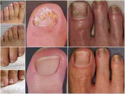 Рідина Бережнова від грибка нігтів на ногах: застосування, склад, відгуки