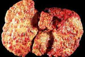 Рідина під печінкою: причини утворення та діагностика