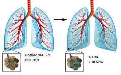 Рідина в легенях при онкології і раку: причини, лікування, прогноз