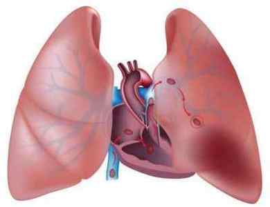 Рідина в легенях: причини, лікування, наслідки