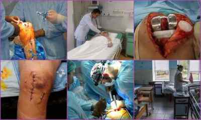 Реабілітація після операції ендопротезування колінного суглоба