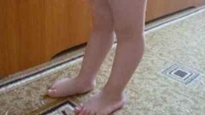Рекурвація колінного суглоба: що це таке, лікування у дитини і дорослого, причини | Ревматолог