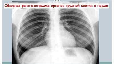 Рентген грудної клітини: що показує рентгенографія органів, чим відрізняється рентген від флюорографії, як часто можна робити | Ревматолог