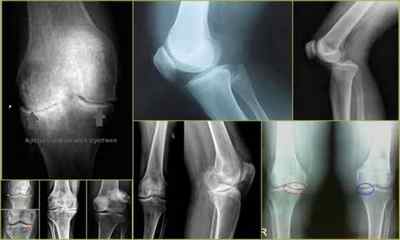 Рентген колінного суглоба: що показує знімок, фото, як проводиться, ціна