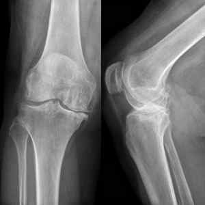 Рентген колінного суглоба: що показує знімок у двох проекціях, здорового суглоба і артрозу, скільки коштує і де зробити | Ревматолог