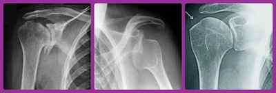 Рентген плечового суглоба: що показує рентгенографія плеча, знімок ліктьового суглоба і передпліччя | Ревматолог