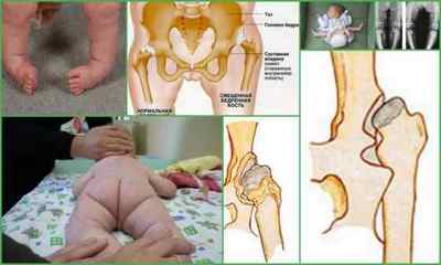 Рентген тазостегнових суглобів у дітей при дисплазії: норми кутів, опис процедури