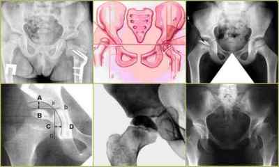 Рентген тазостегнових суглобів у дітей при дисплазії: норми кутів, опис процедури