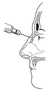Репозиція кісток носа (операція при переломі): показання, проведення