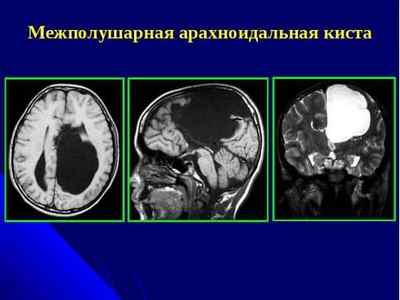 Ретроцеребеллярних кіста головного мозку, чим небезпечна, лікування