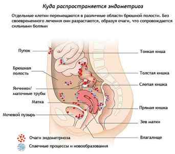 Ретроцервікального ендометріоз: причини, лікування