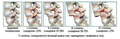 Ретролістез l5 l4 хребця: що це таке, спондилолістез попереково крижового відділу хребта, антелістез | Ревматолог