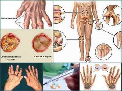 Ревматичний артрит: причини, симптоми, лікування
