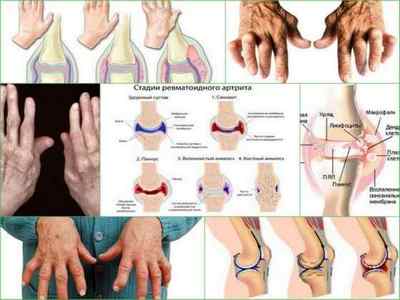 Ревматичний артрит і ревматоїдний артрит - відмінності, особливості симптоматики і лікування