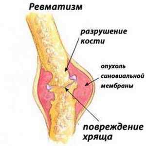 Ревматизм ніг: ознаки і лікування народними засобами в домашніх умовах, діагностика і етіологія, причини і симптоми, дієта | Ревматолог