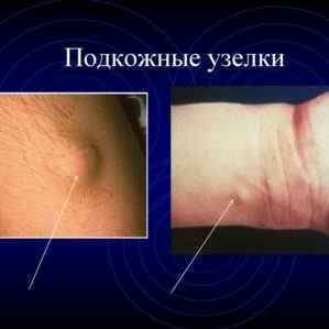 Ревматоїдні вузлики: лікування підшкірних ревматичних вузлів | Ревматолог