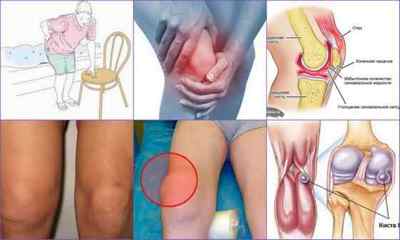Ревматоїдний артрит колінного суглоба: симптоми, лікування, фото, причини, діагностика