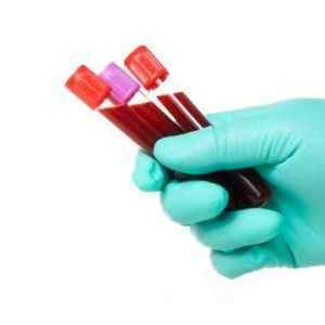 Ревмопроби: що це за аналіз крові, норма, таблиця і розшифровка, що показує і як здавати, що визначають ревмотести | Ревматолог