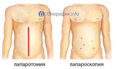 Резекція кишечника: тонкої і товстої кишки (операція видалення її частини органу)